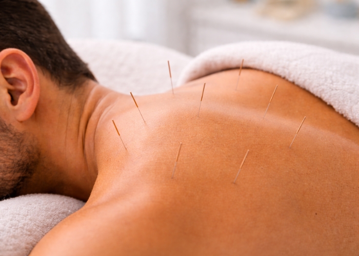 Acupuntura en Murcia