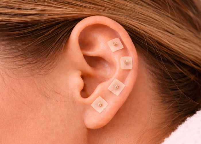 Auriculoterapia