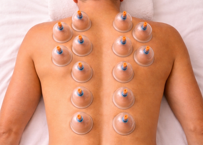 Ventosas cupping terapia